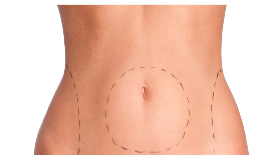 Abdominoplastia-Guadalajara-Dr-Antonio-Mere-Cirujano-Plastico-Guadalajara_v002