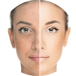 Dr-Antonio-Mere-Cirujano-Plastico-Cirugia-Plastica-y-Estetica-Tratamiento-para-el-Acne-Guadalajara_Queretaro_v001-compressor